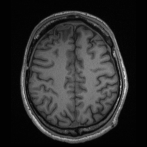 File:Cerebral hemorrhagic contusions- temporal evolution (Radiopaedia 40224-42757 Axial T1 57).png