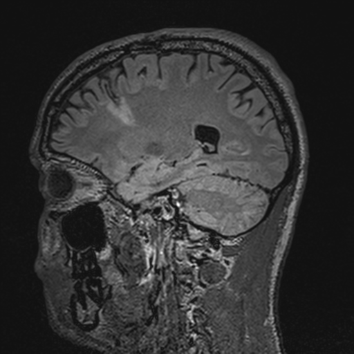 File:Cerebral hemorrhagic contusions- temporal evolution (Radiopaedia 40224-42757 Sagittal T1 29).png