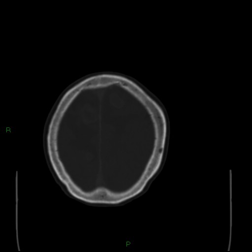 File:Cerebral metastases - breast primary (Radiopaedia 77653-89857 Axial bone window 99).jpg