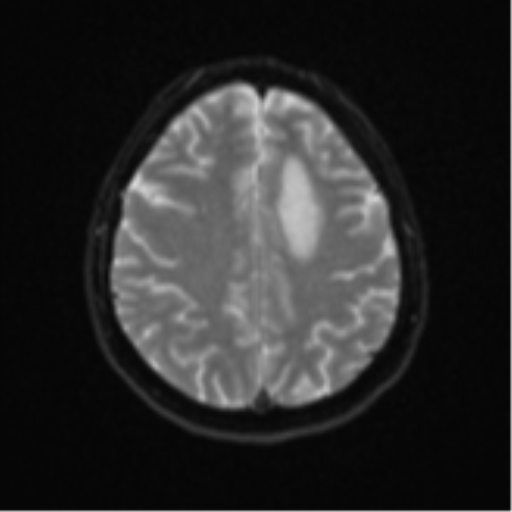 Cerebral metastases mimicking abscesses (Radiopaedia 45841-50131 Axial DWI 21).png