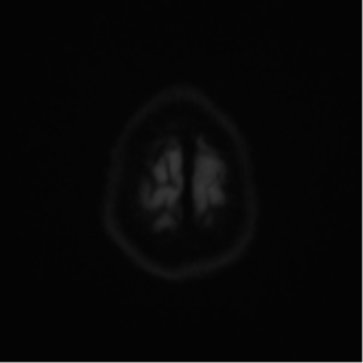 Cerebral metastases mimicking abscesses (Radiopaedia 45841-50131 Axial DWI 55).png