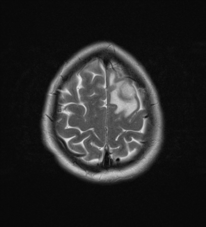 File:Cerebral metastases mimicking abscesses (Radiopaedia 45841-50131 Axial T2 25).png