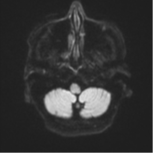 File:Cerebral metastasis (Radiopaedia 46744-51248 Axial DWI 32).png