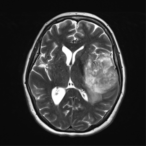 File:Cerebral metastasis mimicking glioblastoma (Radiopaedia 69155-78937 Axial T2 22).png