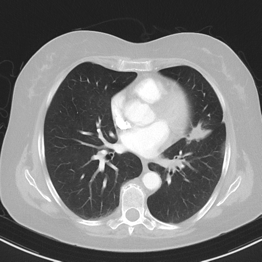 File:Cerebral metastasis mimicking glioblastoma (Radiopaedia 69155-78938 Axial lung window 26).png