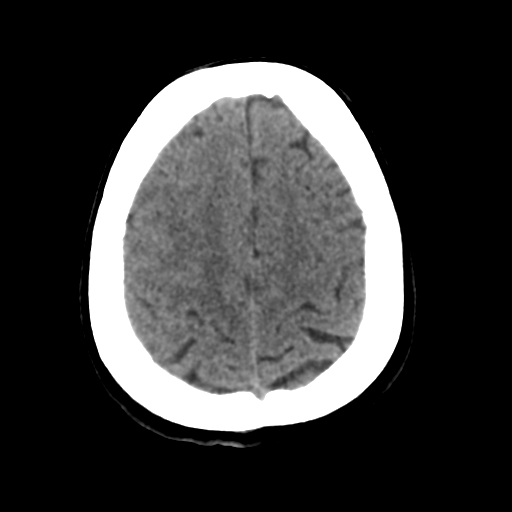 Cerebral metastasis to basal ganglia (Radiopaedia 81568-95412 Axial non-contrast 49).png