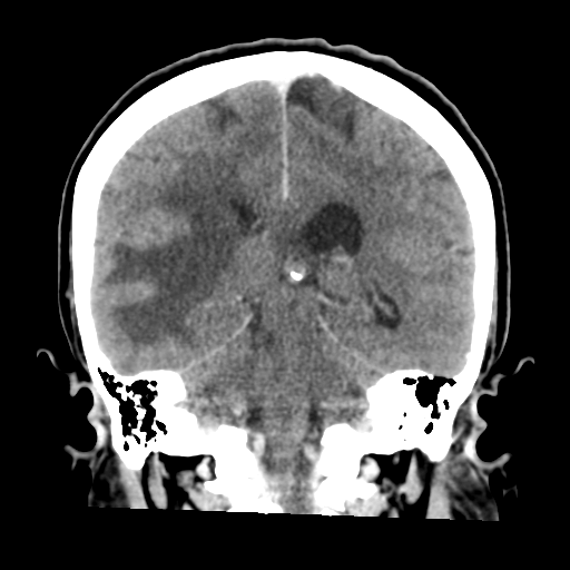 Cerebral metastasis to basal ganglia (Radiopaedia 81568-95412 Coronal C+ delayed 39).png