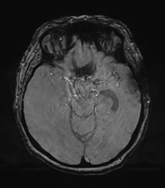 Cerebral metastasis to basal ganglia (Radiopaedia 81568-95413 Axial SWI magnitude 32).png