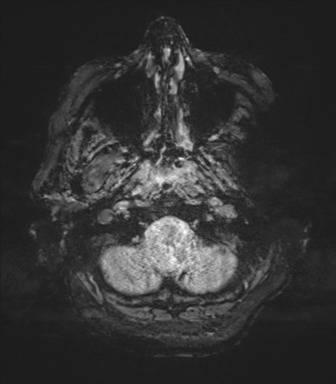 Cerebral metastasis to basal ganglia (Radiopaedia 81568-95413 Axial SWI magnitude 6).png
