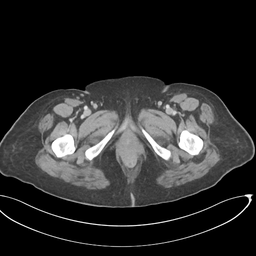 File:Cerebral metastasis to basal ganglia (Radiopaedia 81568-95414 E 83).png