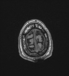 Cerebral toxoplasmosis (Radiopaedia 43956-47461 Axial T1 75).jpg