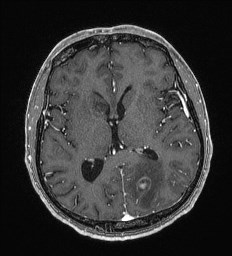 Cerebral toxoplasmosis (Radiopaedia 43956-47461 Axial T1 C+ 38).jpg