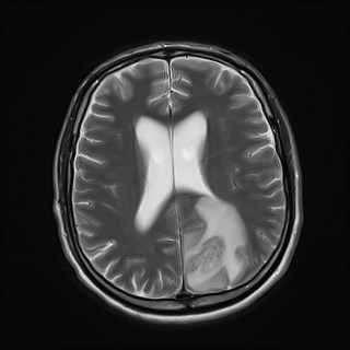 File:Cerebral toxoplasmosis (Radiopaedia 43956-47461 Axial T2 14).jpg