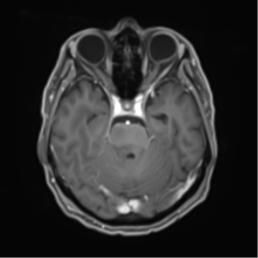 Cerebral toxoplasmosis (Radiopaedia 54575-60804 Axial T1 C+ 20).png