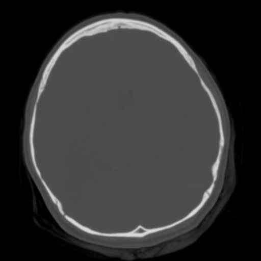 File:Cerebral tuberculosis with dural sinus invasion (Radiopaedia 60353-68018 Axial bone window 27).jpg