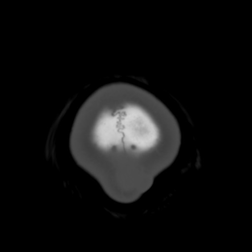 File:Cerebral tuberculosis with dural sinus invasion (Radiopaedia 60353-68018 Axial bone window 67).jpg