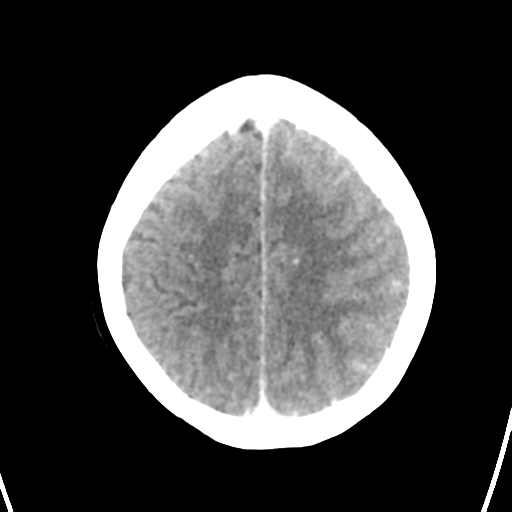 Cerebral venous hemorrhagic infarction (Radiopaedia 57576-64538 Axial C+ 37).png
