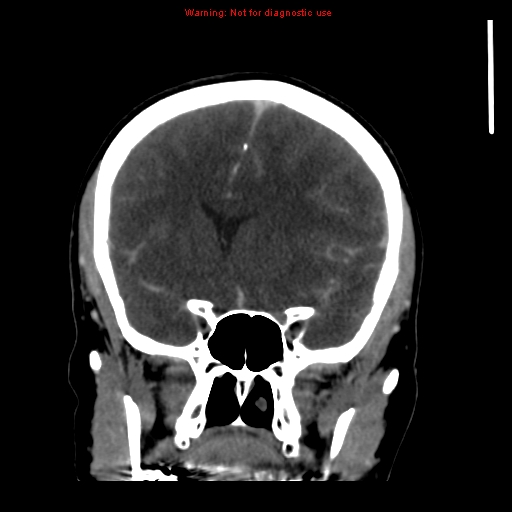 Cerebral venous infarction (Radiopaedia 12404-20735 B 29).jpg