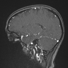 Cerebral venous infarction - hemorrhagic (Radiopaedia 81625-95505 Sagittal MRV 50).jpg