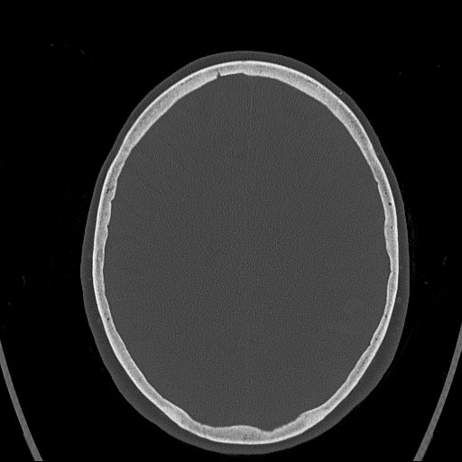 Cerebral venous infarction with hemorrhage (Radiopaedia 65343-74381 Axial bone window 122).jpg