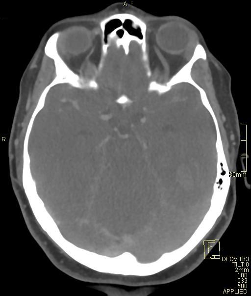 Cerebral venous sinus thrombosis (Radiopaedia 91329-108965 Axial venogram 32).jpg