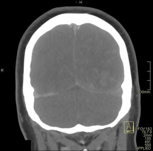 Cerebral venous sinus thrombosis (Radiopaedia 91329-108965 Coronal venogram 73).jpg