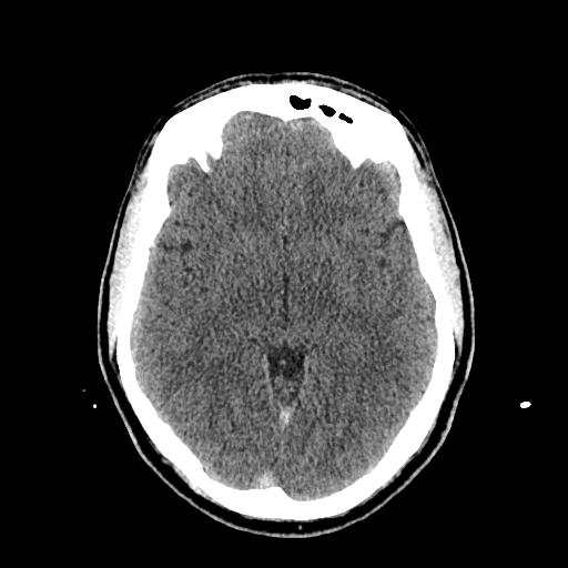 File:Cerebral venous thrombosis (CVT) (Radiopaedia 77524-89685 Axial non-contrast 22).jpg