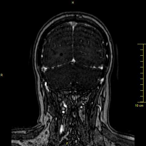 Cerebral venous thrombosis (Radiopaedia 23288-23351 MRV 141).JPG