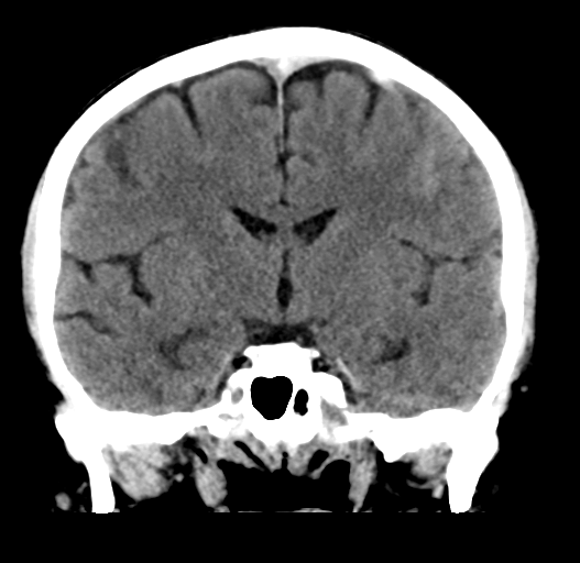 File:Cerebral venous thrombosis (Radiopaedia 38392-40467 Coronal non-contrast 19).png