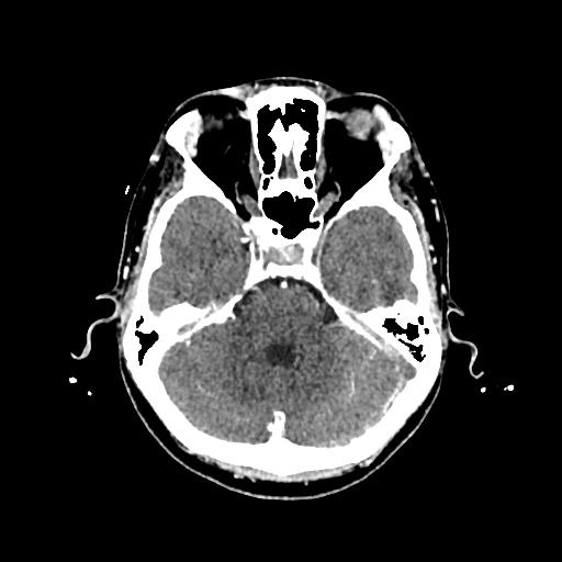 File:Cerebral venous thrombosis with venous hemorrhagic infarct (Radiopaedia 90354-107660 Axial with contrast 52).jpg