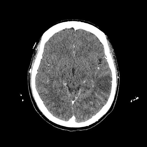Cerebral venous thrombosis with venous hemorrhagic infarct (Radiopaedia 90354-107660 Axial with contrast 77).jpg