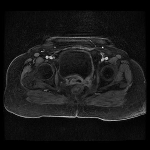 Cervical carcinoma (Radiopaedia 70924-81132 Axial T1 C+ fat sat 129).jpg