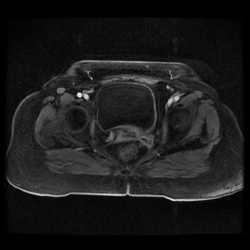 Cervical carcinoma (Radiopaedia 70924-81132 Axial T1 C+ fat sat 44).jpg
