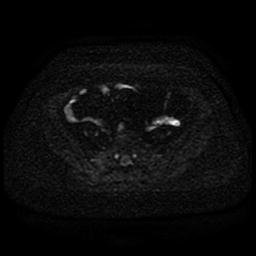 Cervical carcinoma (Radiopaedia 85405-101028 Axial DWI 38).jpg