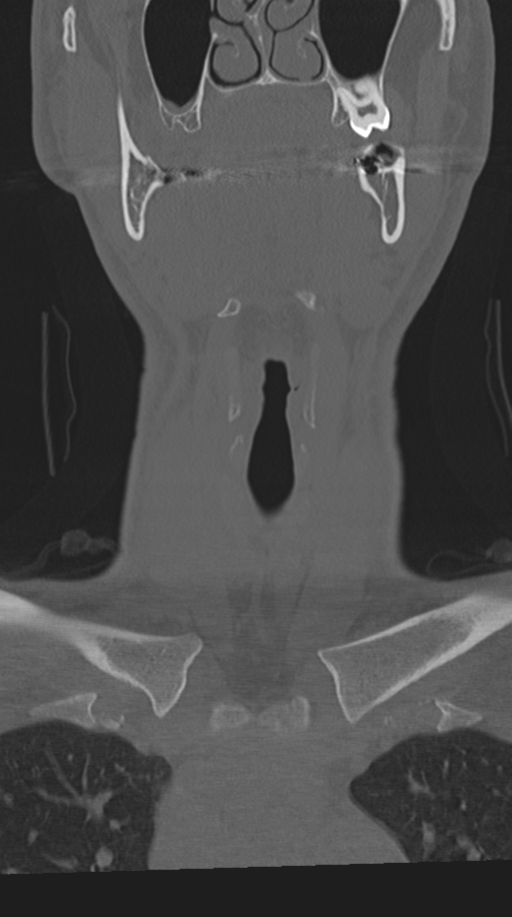 Cervical intercalary bone (Radiopaedia 35211-36748 Coronal bone window 5).png