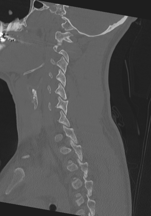 Cervical intercalary bone (Radiopaedia 35211-36748 Sagittal bone window 27).png