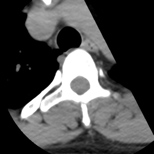 Cervical schwannoma (Radiopaedia 57979-64974 Axial non-contrast 74).png