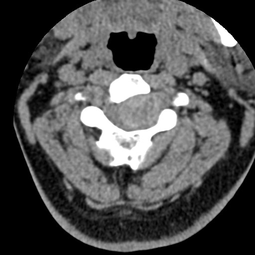 File:Cervical spinal neurofibroma in a patient with NF1 (Radiopaedia 58344-65464 Axial non-contrast 26).jpg