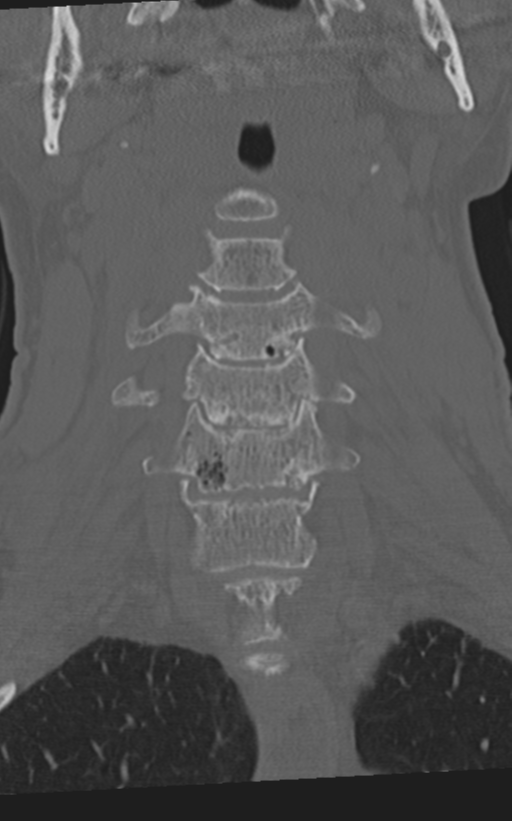 Cervical spine fractures with vertebral artery dissection (Radiopaedia 53296-59268 Coronal bone window 22).png
