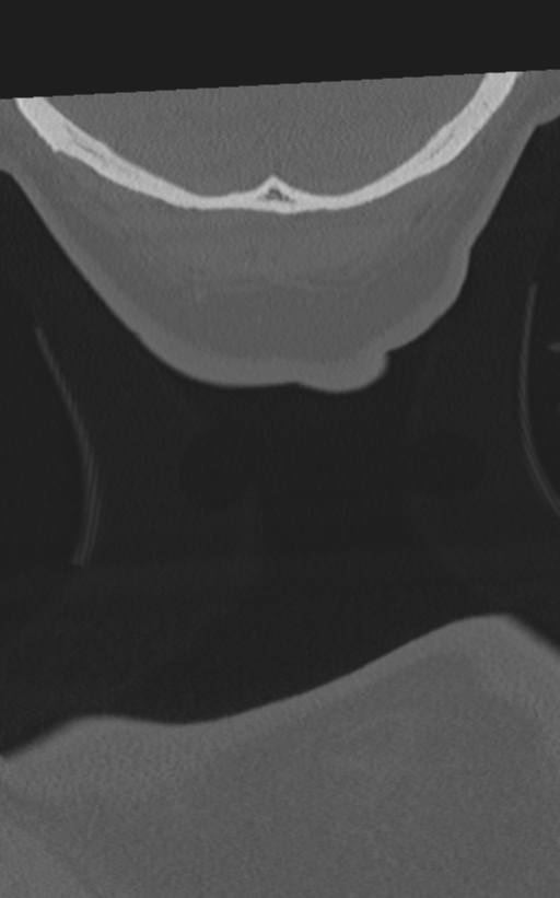 Cervical spine fractures with vertebral artery dissection (Radiopaedia 53296-59268 Coronal bone window 84).png