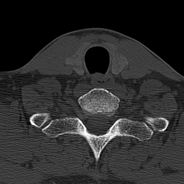 Cervical spondylodiscitis (Radiopaedia 28057-29489 Axial bone window 65).jpg