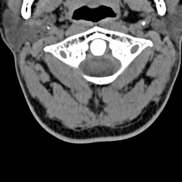 File:Cervical spondylodiscitis (Radiopaedia 28057-29489 Axial non-contrast 18).jpg