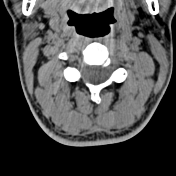 File:Cervical spondylodiscitis (Radiopaedia 28057-29489 Axial non-contrast 29).jpg