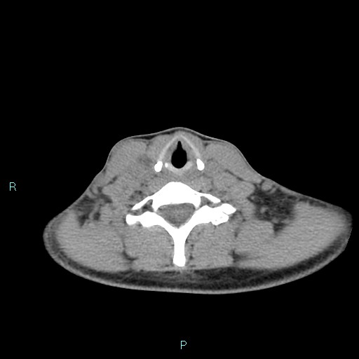 Cervical thymic cyst (Radiopaedia 88632-105335 Axial non-contrast 46).jpg