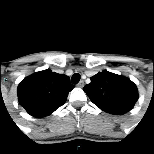 Cervical thymic cyst (Radiopaedia 88632-105335 C 18).jpg