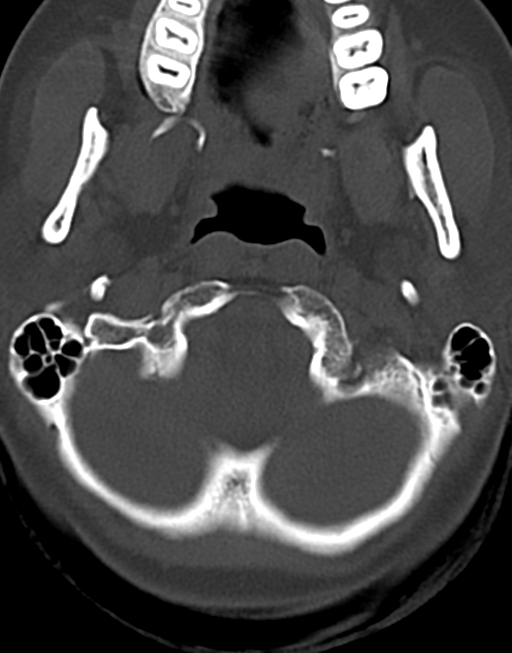 Cervical tuberculous spondylitis (Radiopaedia 39149-41365 Axial bone window 7).png