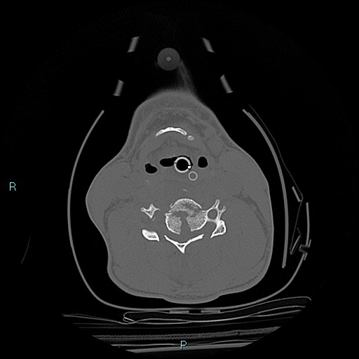 File:Cervical vertebral burst fracture (Radiopaedia 37420-39258 Axial bone window 25).jpg