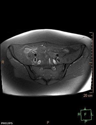 File:Cesarian scar endometriosis (Radiopaedia 68495-78066 Axial T1 fat sat 4).jpg