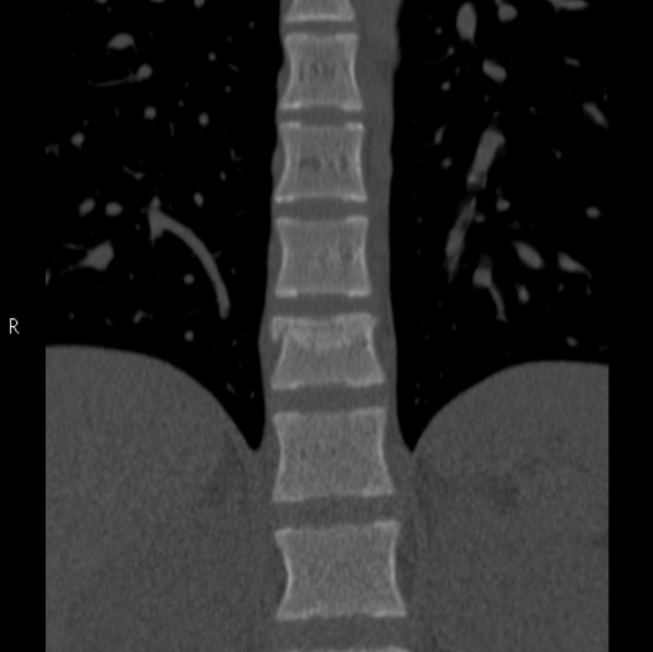 File:Chance fracture (Radiopaedia 36521-38081 Coronal bone window 11).jpg