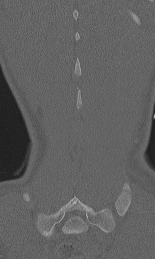 Chance fracture (Radiopaedia 40360-42912 Coronal bone window 64).png
